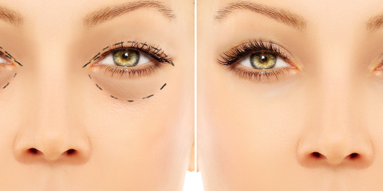 FINANCIACIÓN BLEFAROPLASTIA